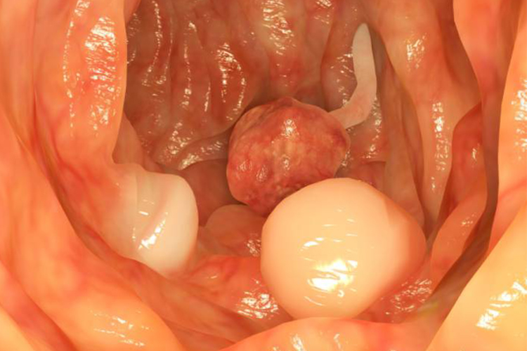 پولیپ رحم (Endometrial Polyps) یک رشد غیرطبیعی در لایه داخلی رحم است.